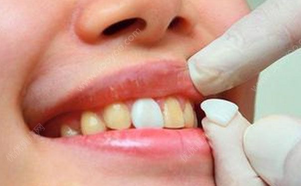 牙齿贴面副作用有哪些-冷眸生活